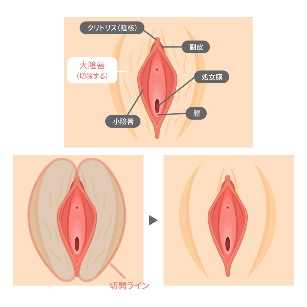 大陰唇 大陰唇脂肪移植（大陰唇増大術） - 表参道レジュバメディカル ...